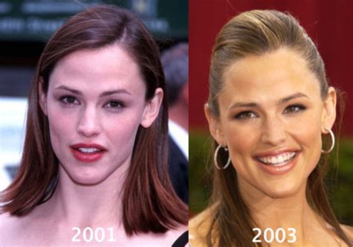 Jennifer Garner Plastic Surgery Before and After