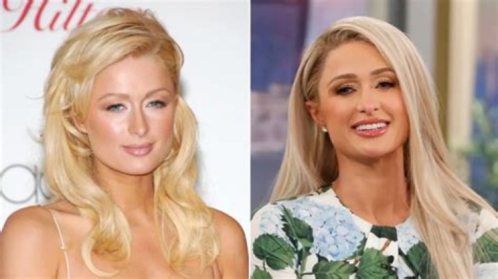 Paris Hilton Breast Implants Plastic Surgery Before and After